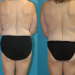Lower Body Lift, Breast Reduction and Lift and Bra Roll Lift - Before and After