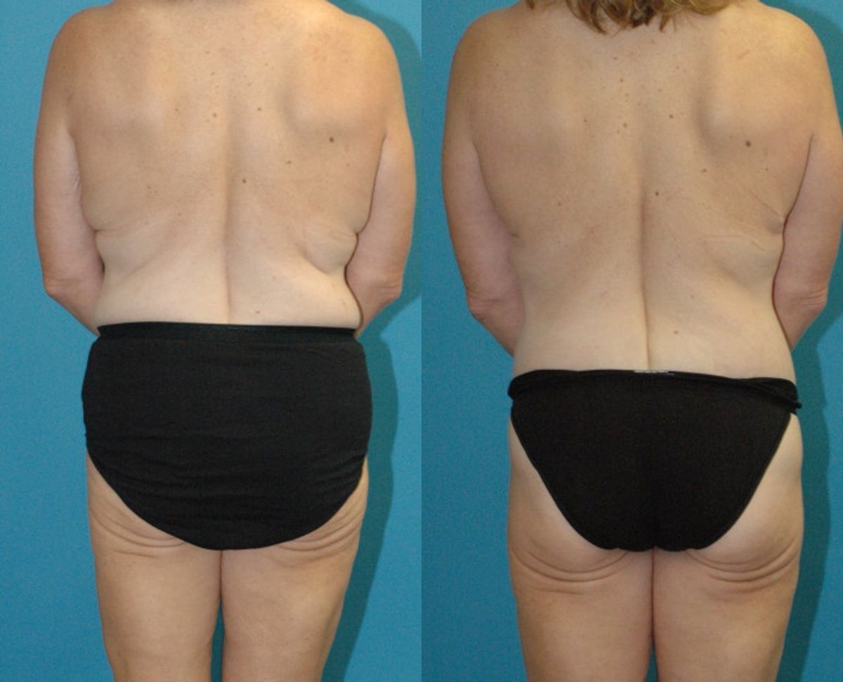 Lower Body Lift, Breast Reduction and Lift and Bra Roll Lift - Before and After