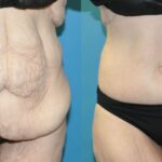 Lower Body Lift #01 - Before and After