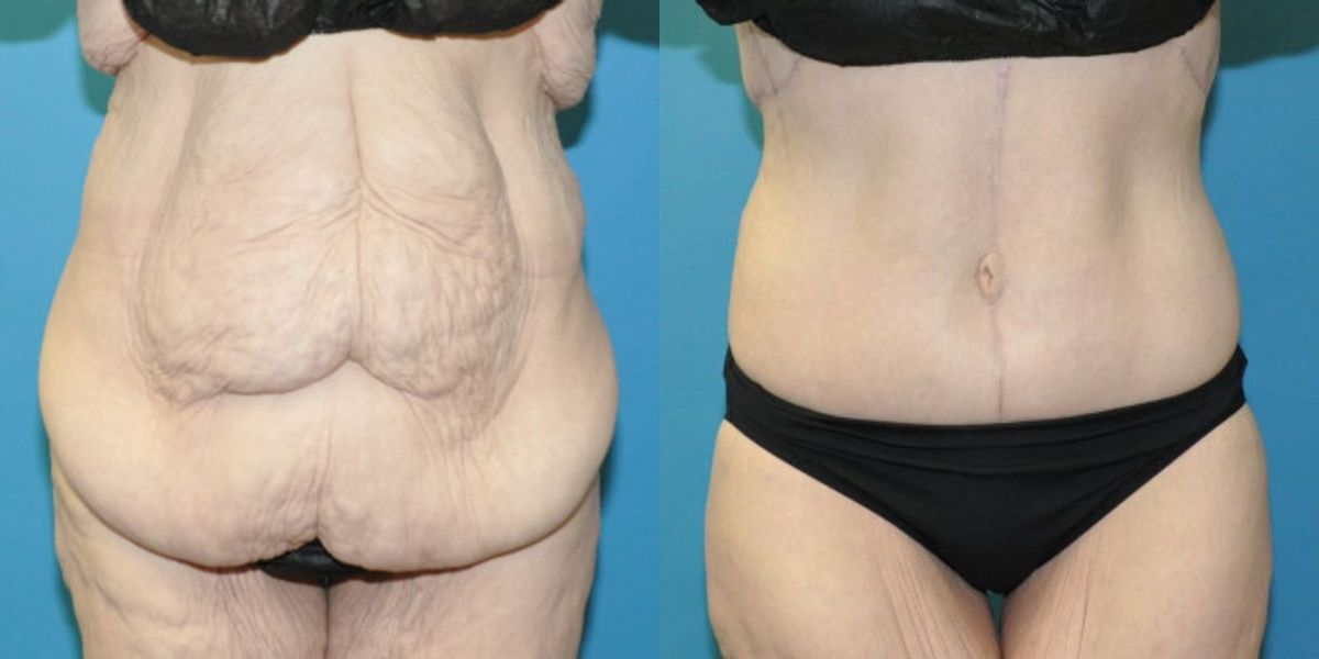 Lower Body Lift #01 - Before and After