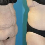 Lower Body Lift #01 - Before and After