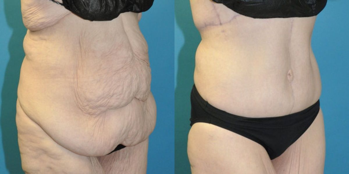 Lower Body Lift #01 - Before and After