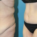 Lower Body Lift #01 - Before and After