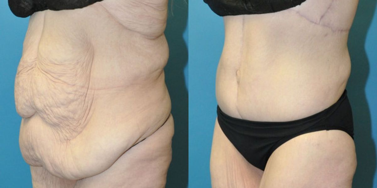 Lower Body Lift #01 - Before and After