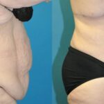 Lower Body Lift #01 - Before and After