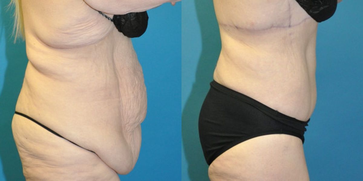 Lower Body Lift #01 - Before and After