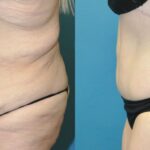 Lower Body Lift #01 - Before and After