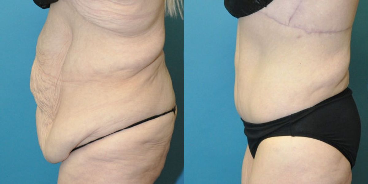 Lower Body Lift #01 - Before and After