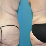 Lower Body Lift #01 - Before and After