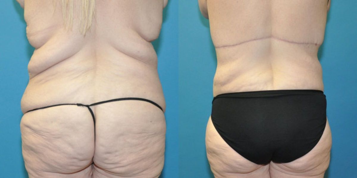 Lower Body Lift #01 - Before and After