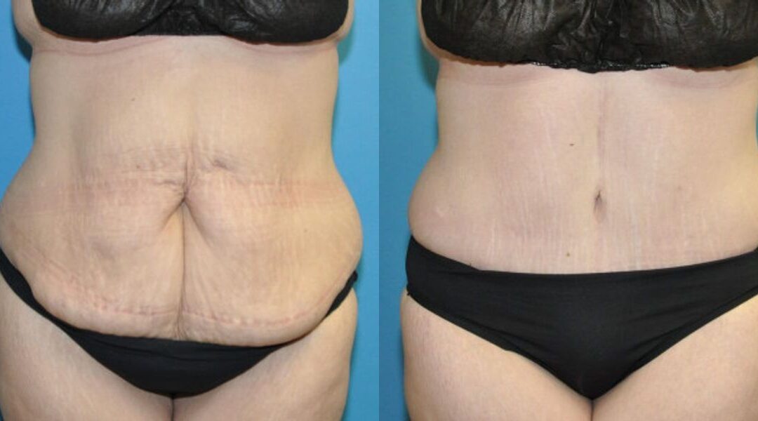 Lower Body Lift with “fleur de lis” #14