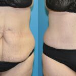 Lower Body Lift with "fleur de lis" #14 - Before and After