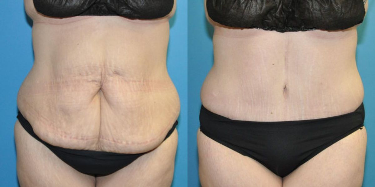 Lower Body Lift with "fleur de lis" #14 - Before and After