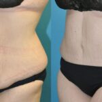 Lower Body Lift with "fleur de lis" #14 - Before and After