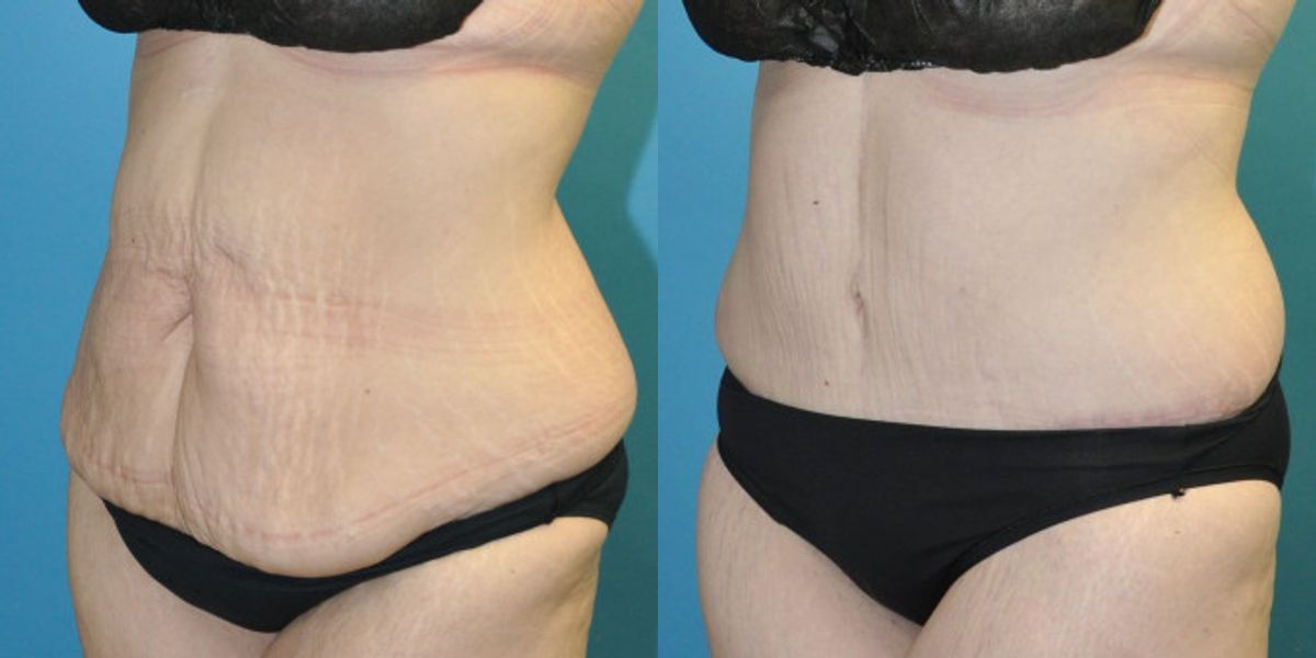 Lower Body Lift with "fleur de lis" #14 - Before and After