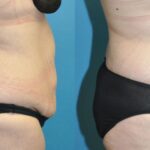 Lower Body Lift with "fleur de lis" #14 - Before and After