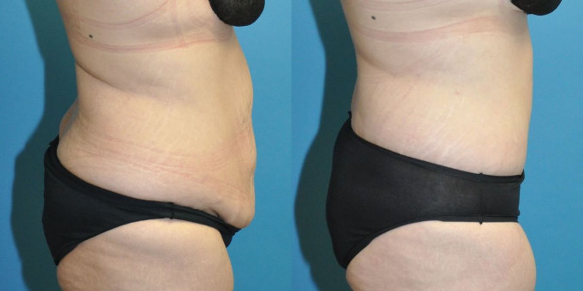 Lower Body Lift with "fleur de lis" #14 - Before and After