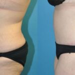 Lower Body Lift with "fleur de lis" #14 - Before and After