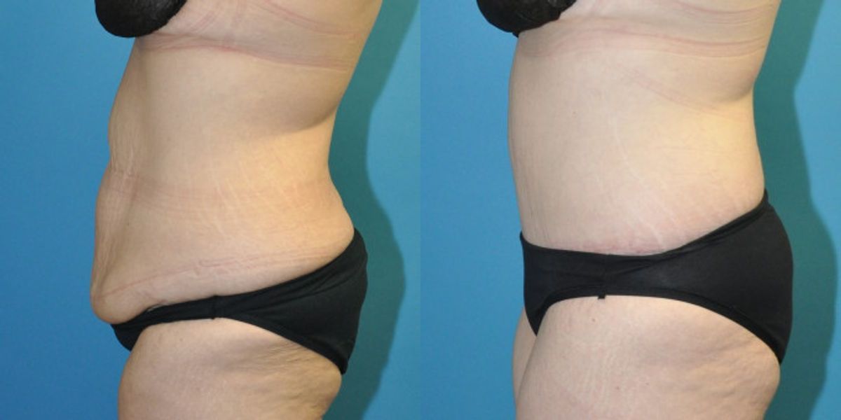 Lower Body Lift with "fleur de lis" #14 - Before and After