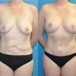 Mommy Makeover #1 - Before and After