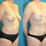 Mommy Makeover #1 - Before and After