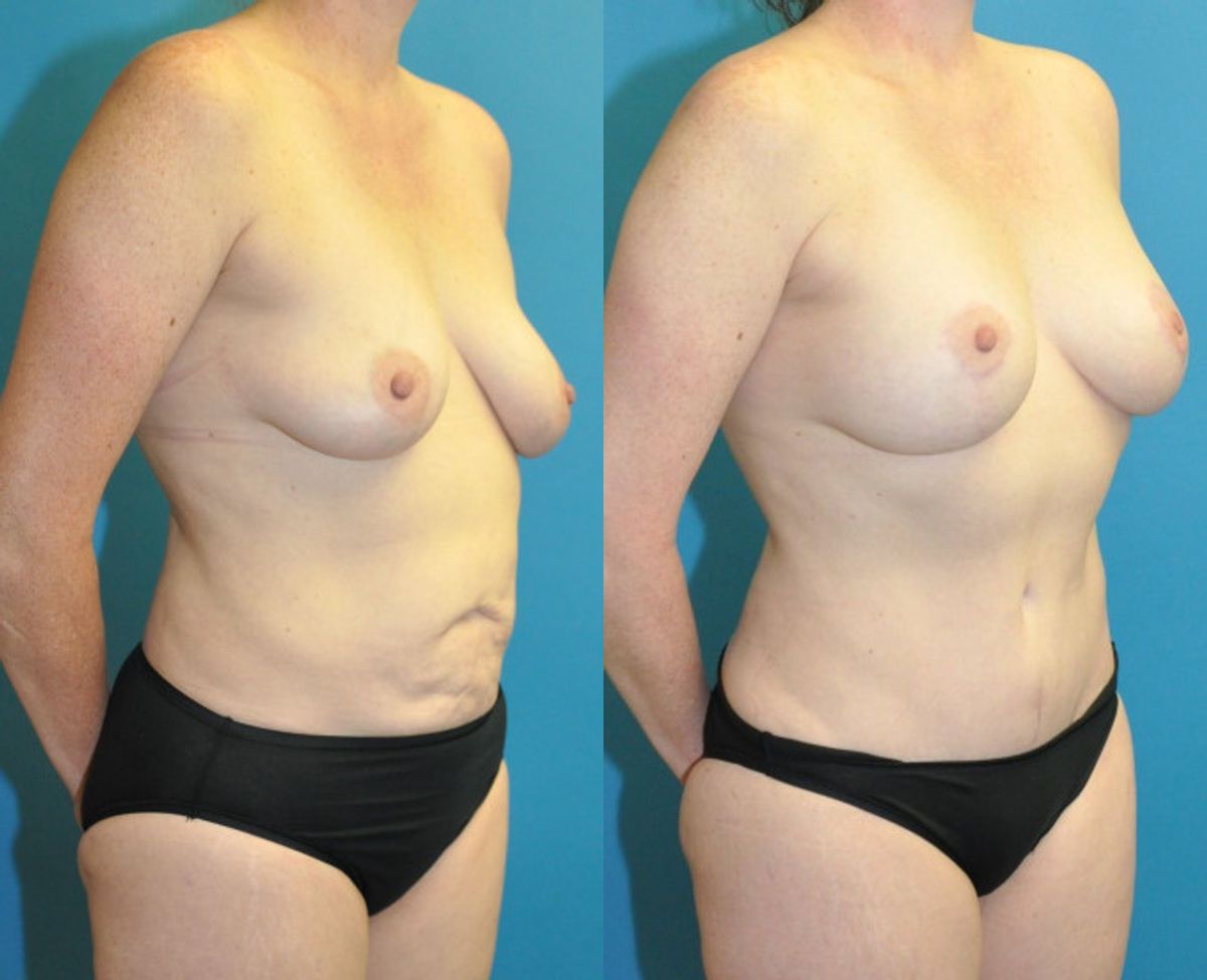 Mommy Makeover #1 - Before and After