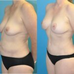 Mommy Makeover #1 - Before and After