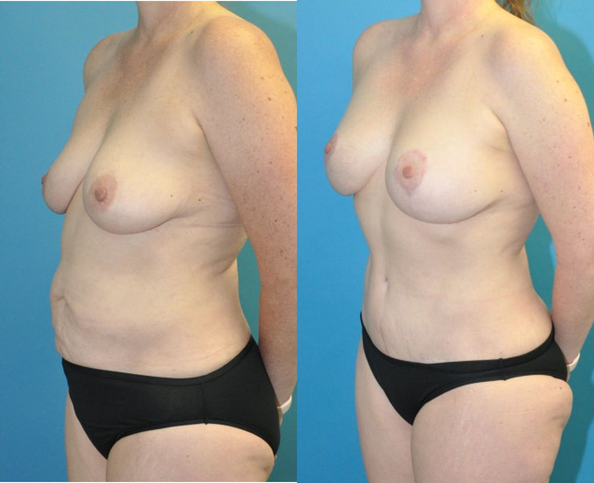 Mommy Makeover #1 - Before and After