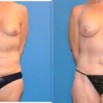 Mommy Makeover #3 - Before and After