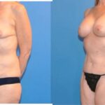 Mommy Makeover #3 - Before and After