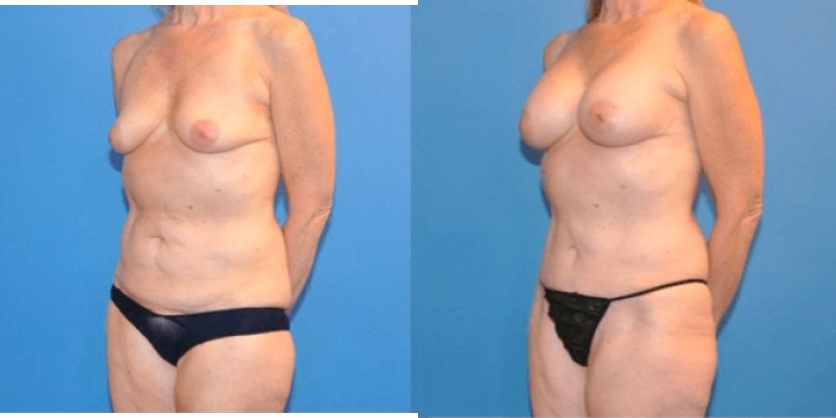 Mommy Makeover #3 - Before and After