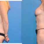 Mommy Makeover #3 - Before and After