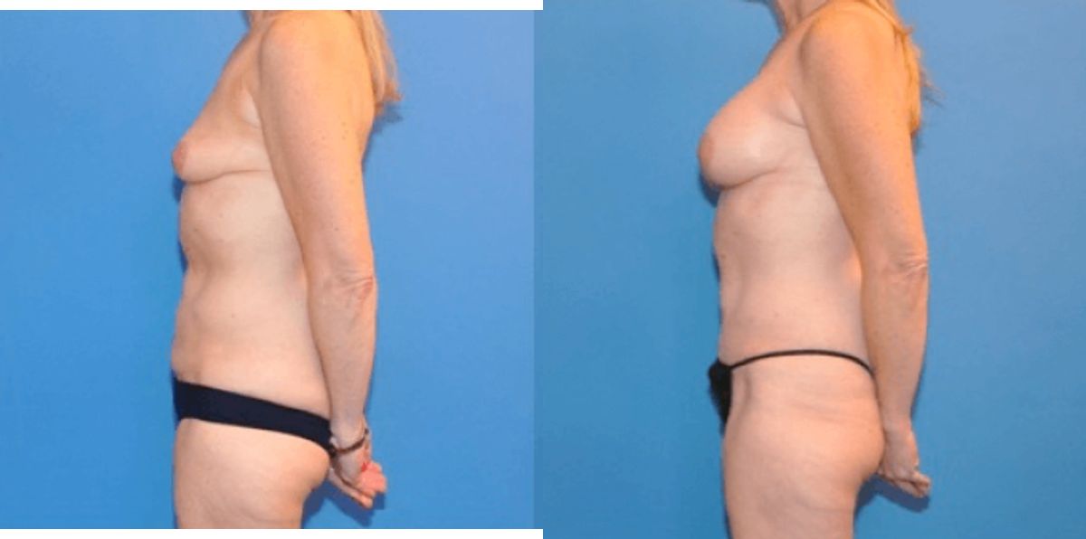 Mommy Makeover #3 - Before and After