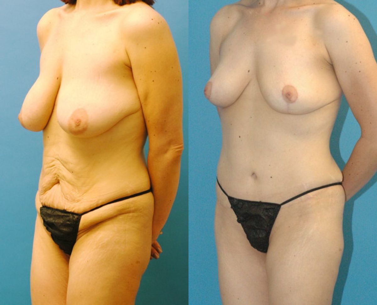 Mommy Makeover #4 - Before and After