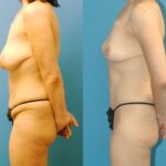 Mommy Makeover #4 - Before and After