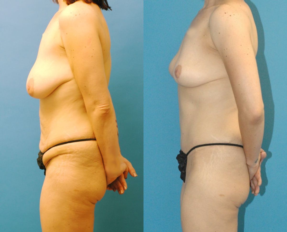 Mommy Makeover #4 - Before and After