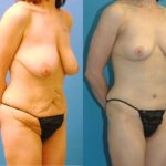 Mommy Makeover #4 - Before and After