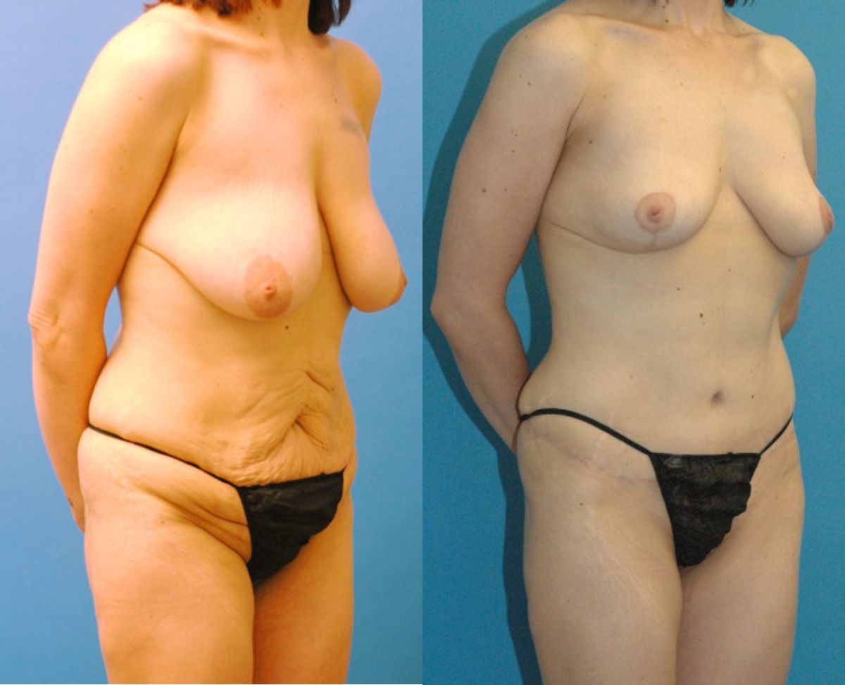 Mommy Makeover #4 - Before and After