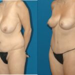 Mommy Makeover #5 - Before and After