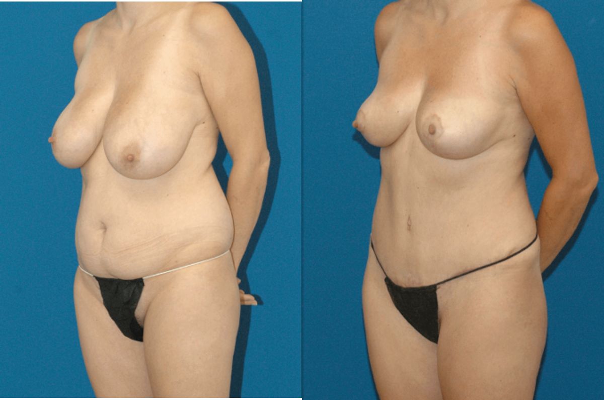 Mommy Makeover #5 - Before and After