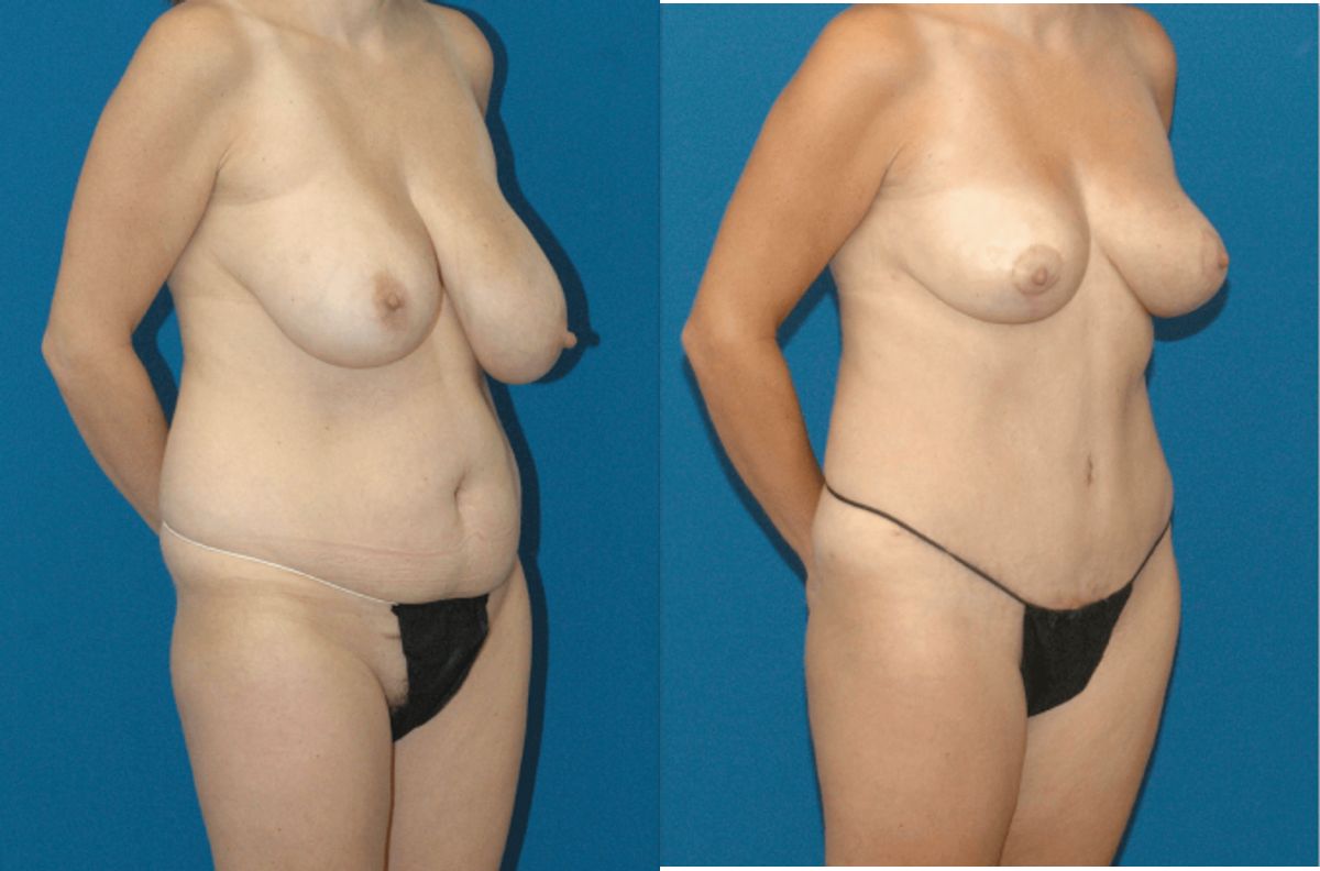 Mommy Makeover #5 - Before and After