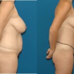 Mommy Makeover #5 - Before and After