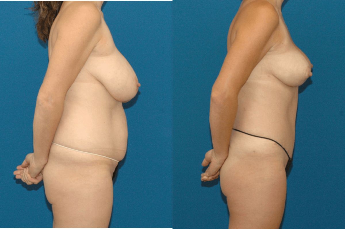 Mommy Makeover #5 - Before and After