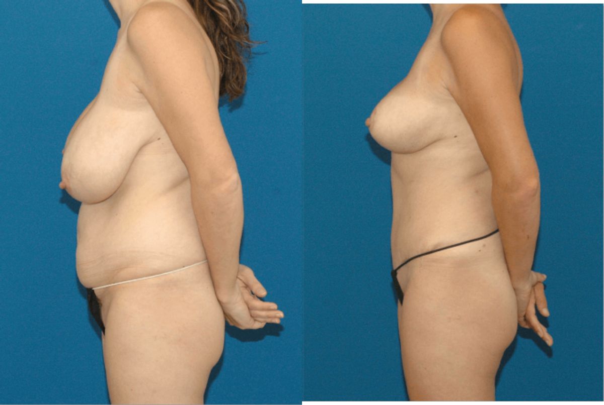 Mommy Makeover #5 - Before and After