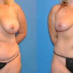 Mommy Makeover #6 - Before and After