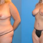 Mommy Makeover #6 - Before and After