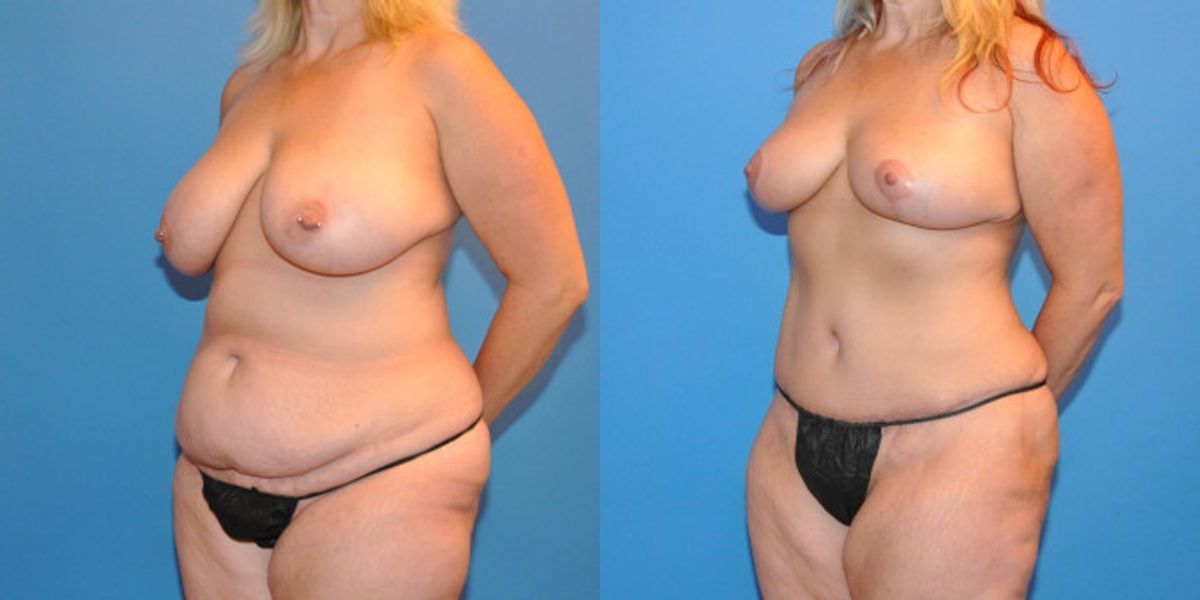 Mommy Makeover #6 - Before and After