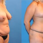 Mommy Makeover #6 - Before and After