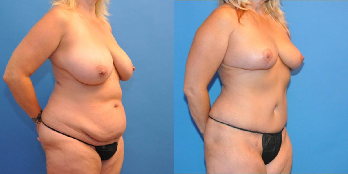 Mommy Makeover #6 - Before and After