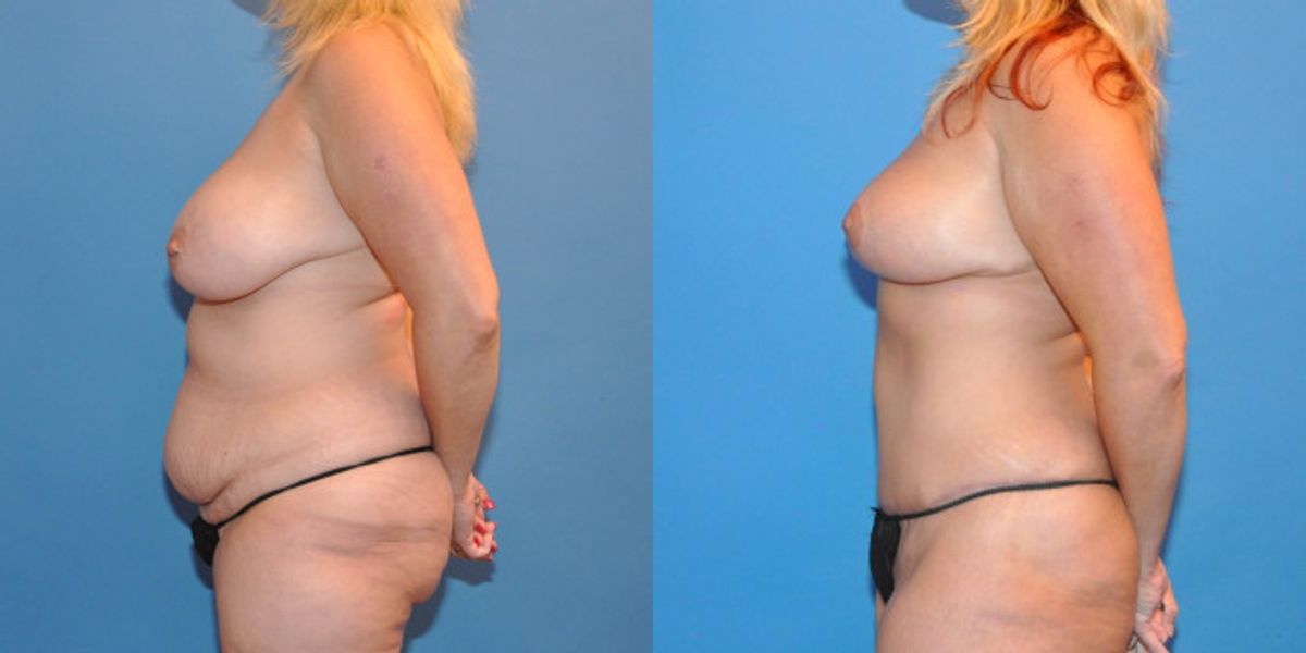 Mommy Makeover #6 - Before and After